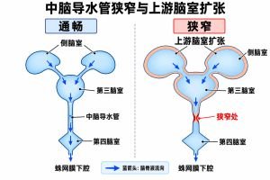 中脑导水管连接第三脑室与第四脑室。导水管狭窄阻碍脑脊液通过，引起上游侧脑室和第三脑室扩张；蓝箭头表示脑脊液流向。